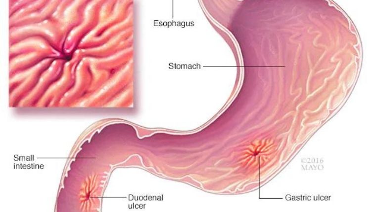 Stomach ulcer explain